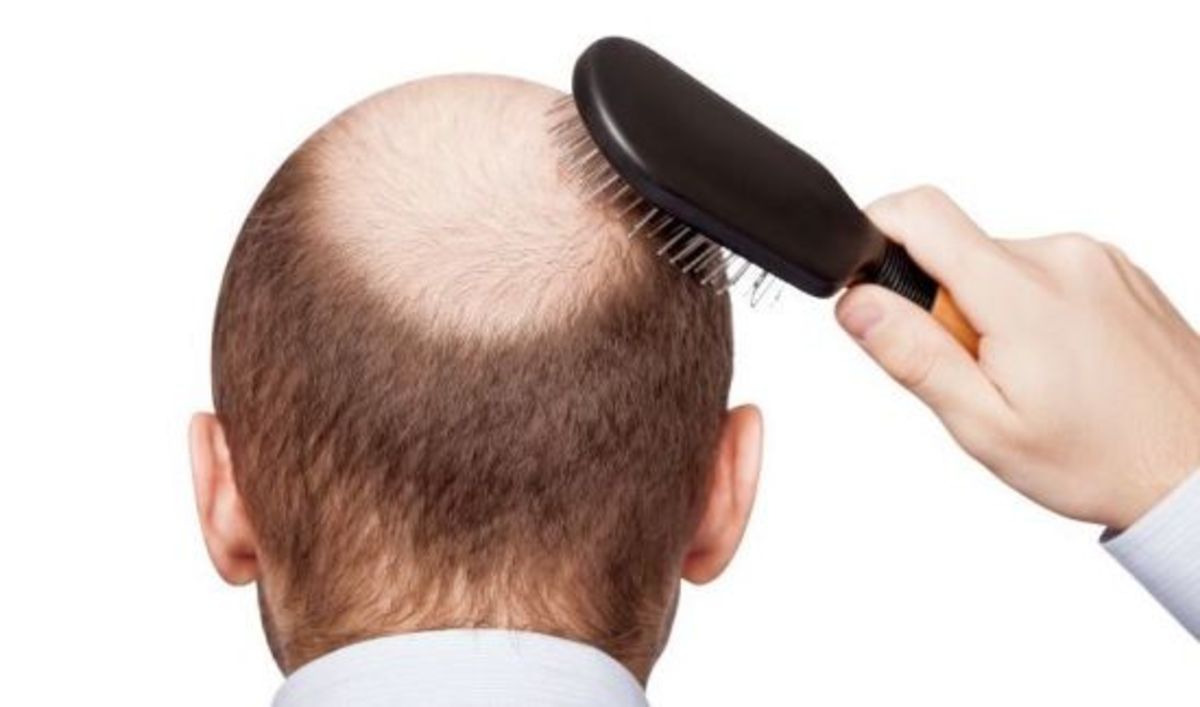 میزان نرمال ریزش مو در آقایان چقدر است؟