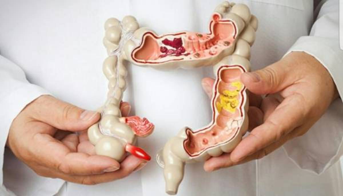 یبوست یکی از علائم اولیه سرطان روده بزرگ