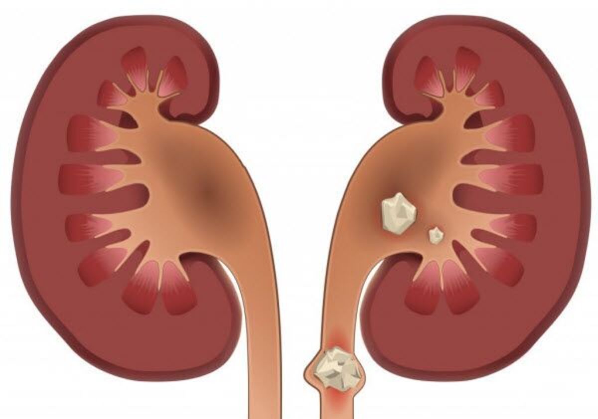 همه چیز درمورد سنگ کلیه؛ از علائم تا عوامل موثر در تشکیل آن