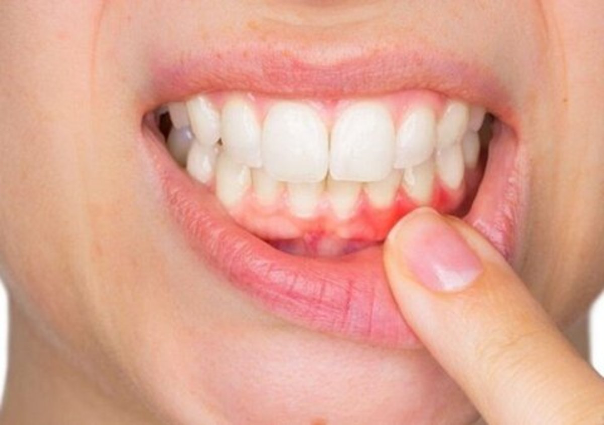 آیا بیماری لثه مسری است؟