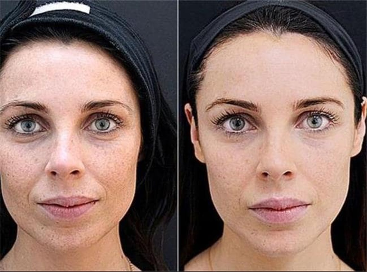 انواع و کاربرد و مزایا مزوژل جالپرو چیست؟