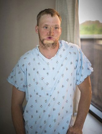 نخستین پیوند صورت برای کسی که بر اثر شلیک گلوله صورت خود را از دست داده بود