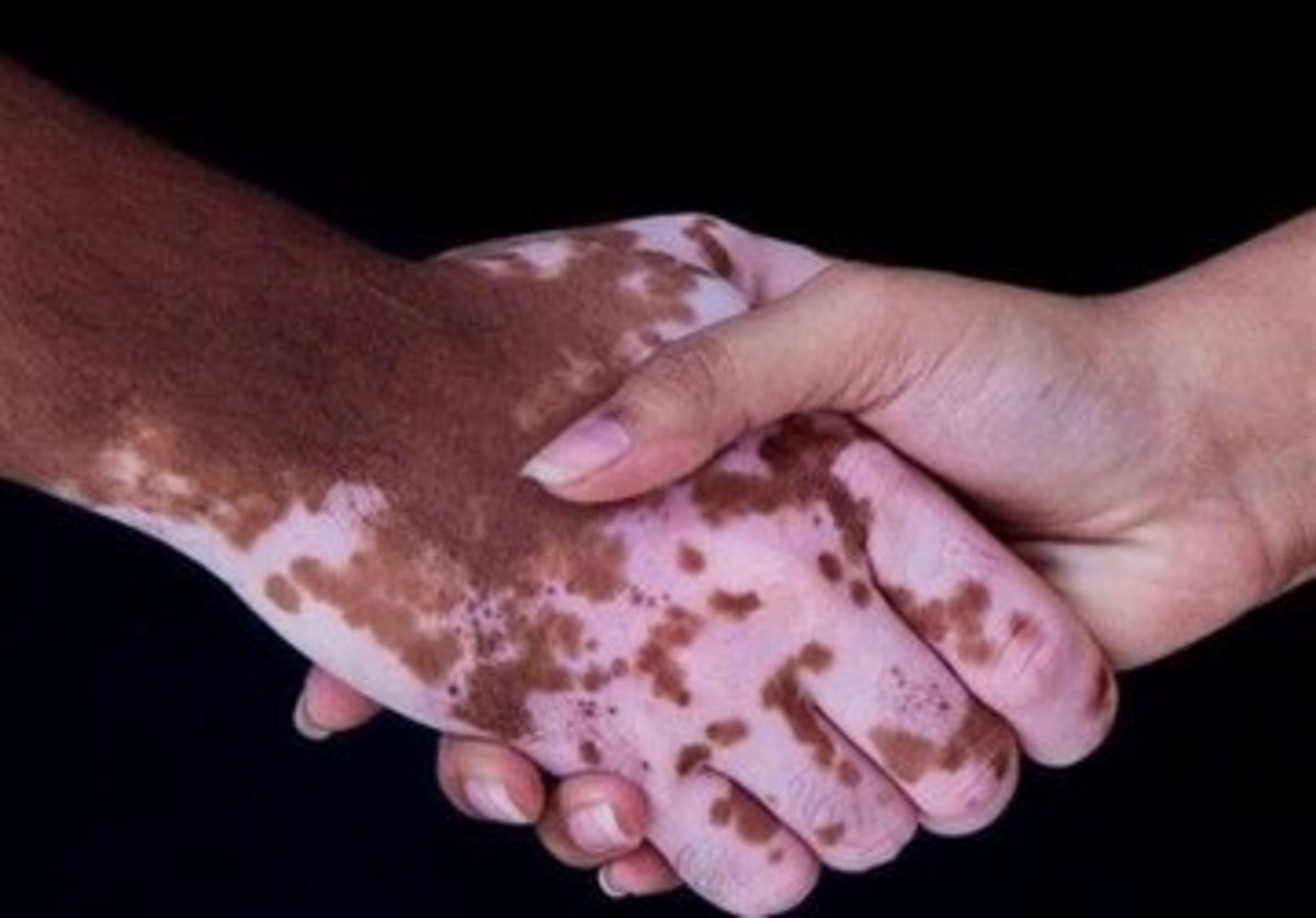 بهترین روش درمان بیماری پوستی ویتیلیگو چیست؟