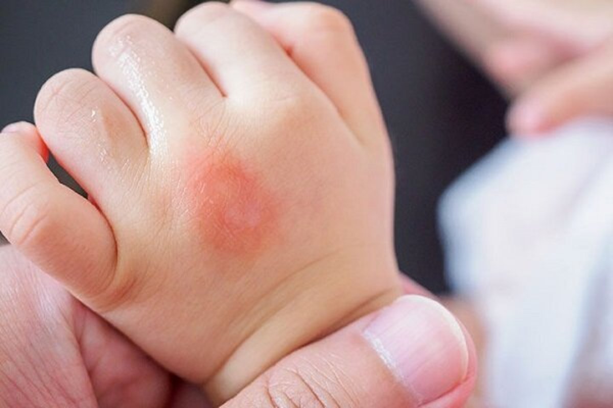 علائم آلرژی در کودکان چه دلیلی دارد؟