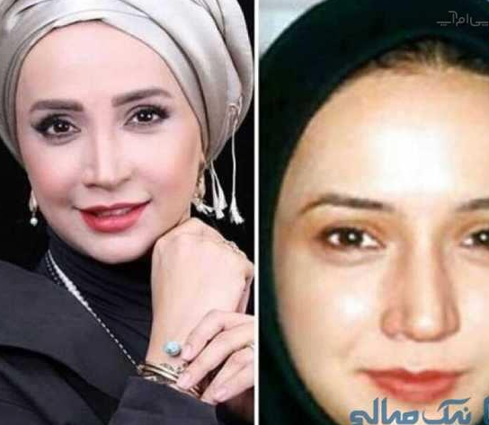 عکس لو رفتن قبل از عمل شبنم قلی خانی جنجالی شد! /عکس