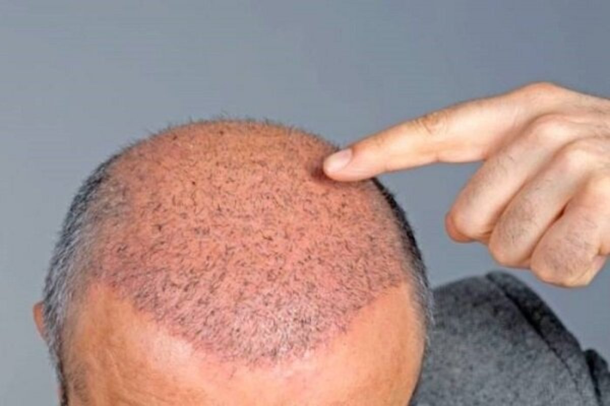 روش‌های کاشت مو برای افرادی که مبتلا به دیابت هستند چگونه است؟