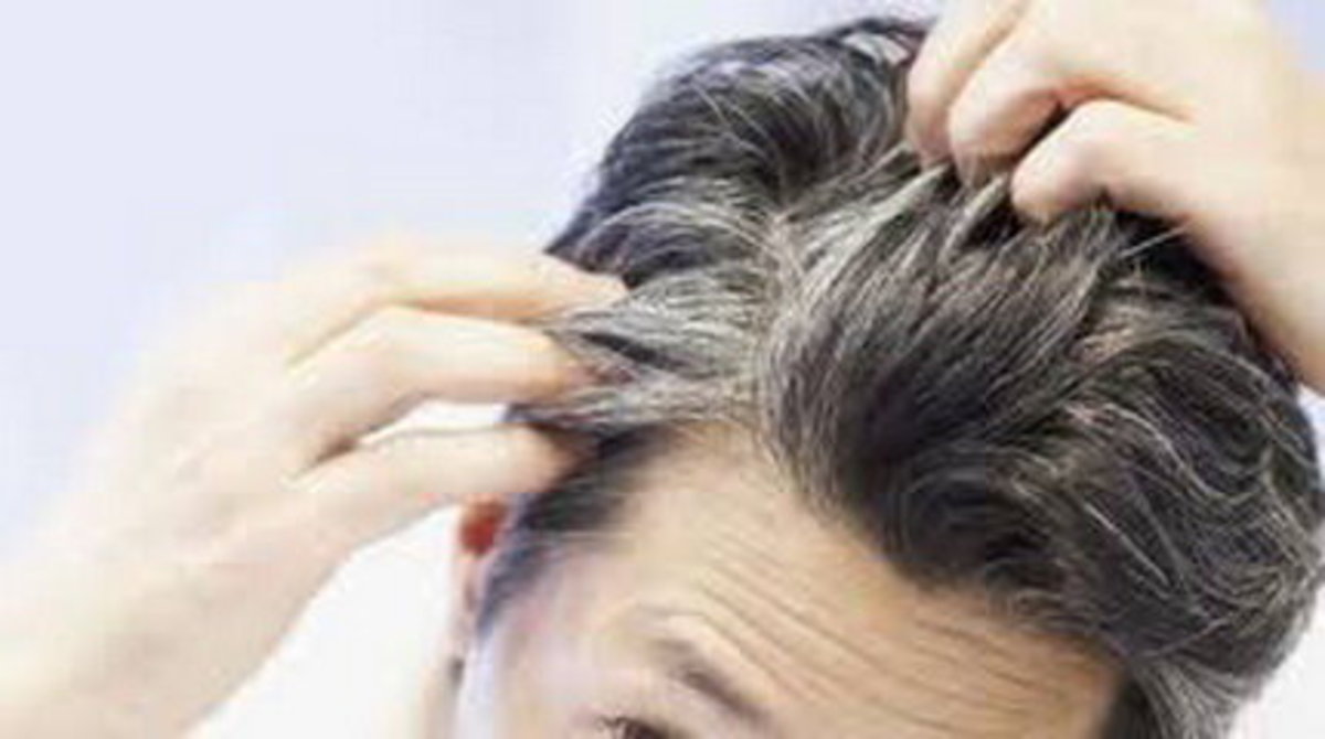 بیماری تیروئید یکی از بیماری‌های تاثیرگذار بر وضعیت موی سر