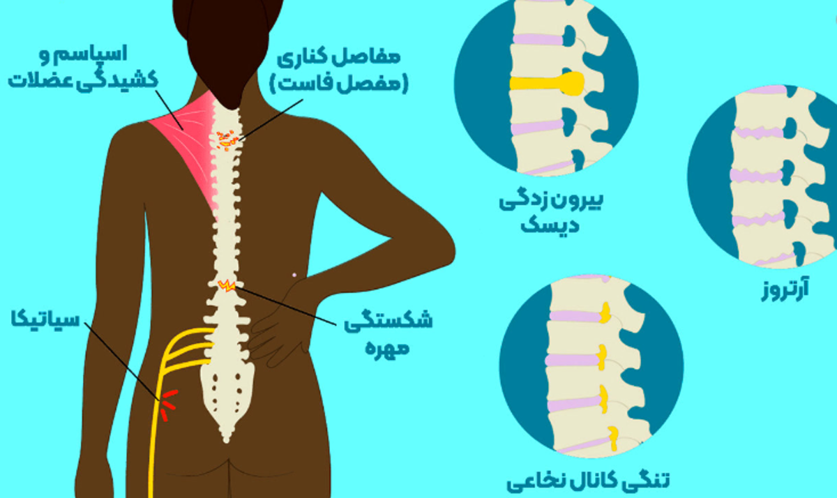حرکات اشتباهی که باعث آسیب رساندن به کمر و مهره‌ها می‌شوند
