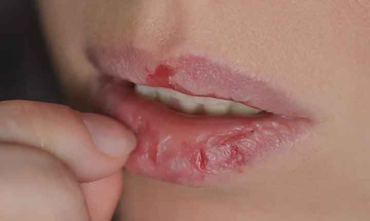چطور از شر ترک لب خلاص شویم؟