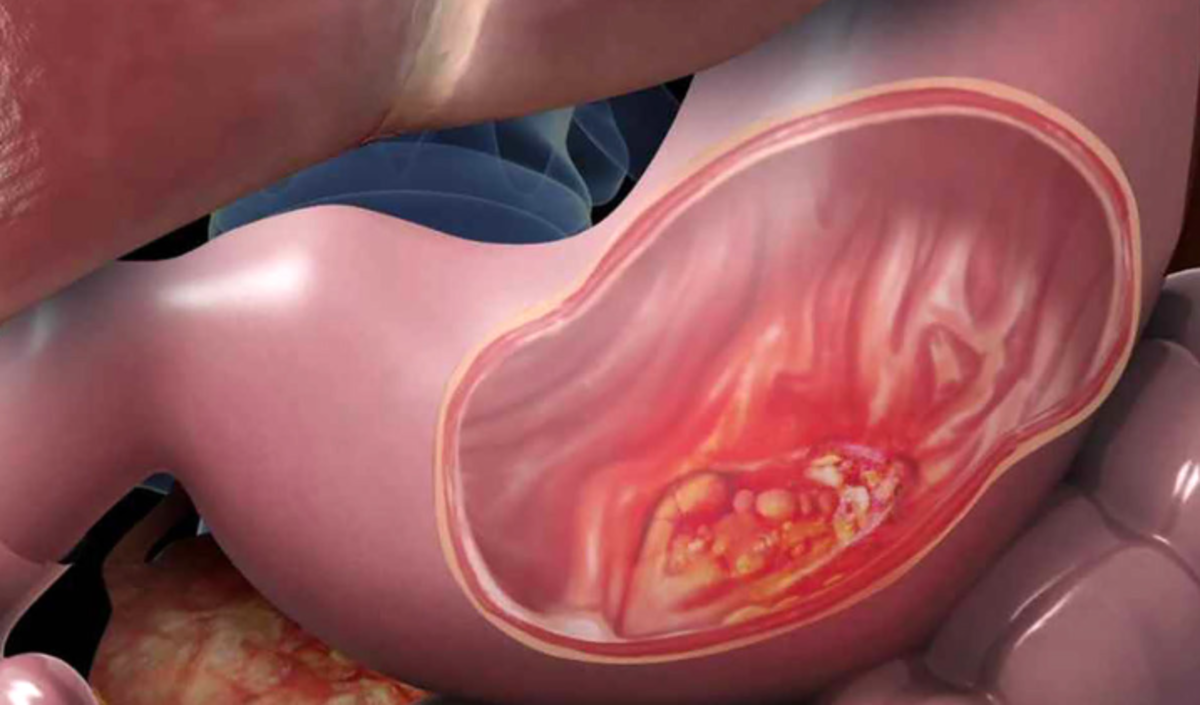 بیماری‌های که معده را تهدید می‌کنند را بشناسید