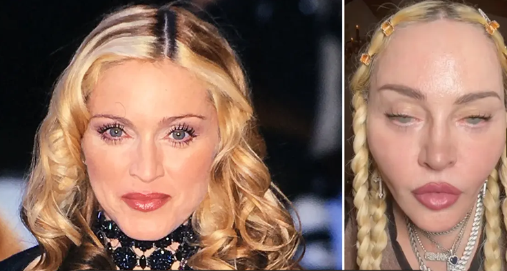 جراحی پلاستیک‌های متعدد مدونا چهره او را ناشناس کرد/قبل و بعد را ببینید