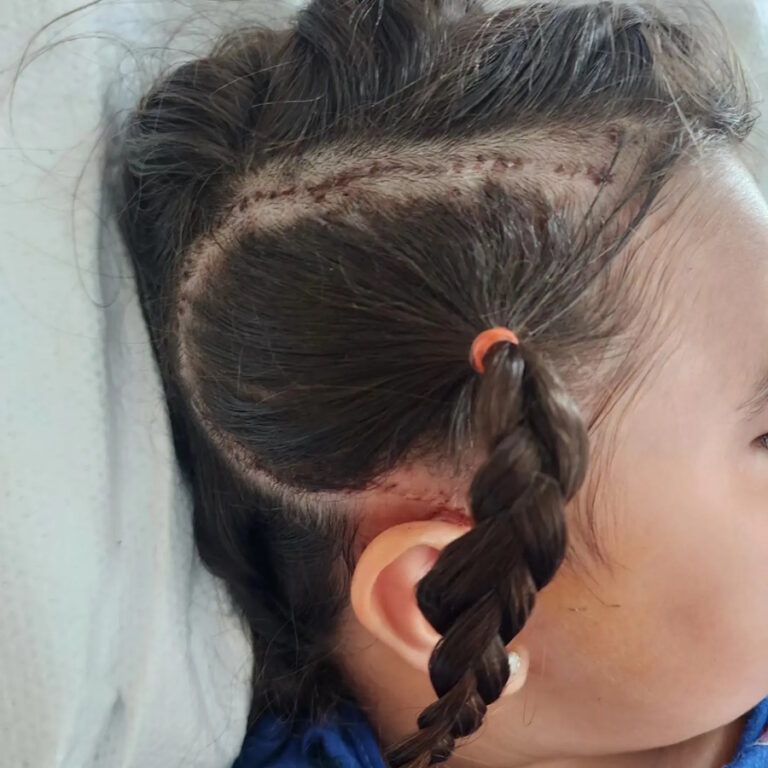 بیماری نادری که منجر به برداشتن نیمی از مغر دختر بچه ۶ ساله شد