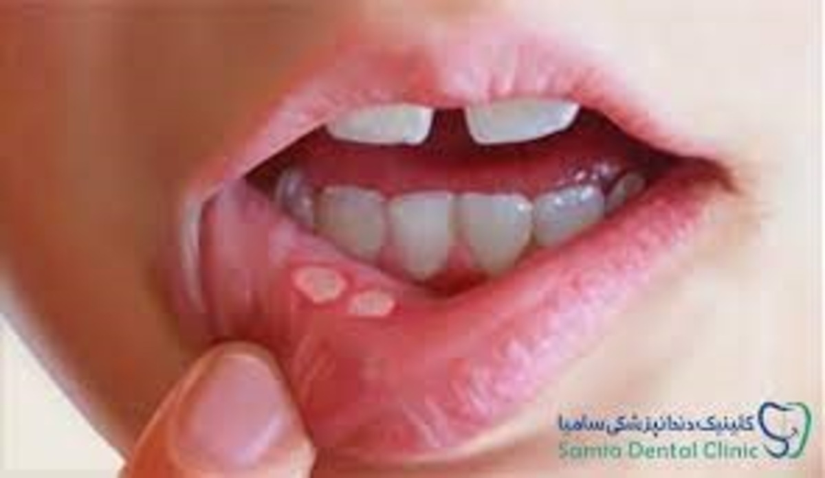 غذا‌هایی که منجر به آفت بر روی زبان و گلو میشوند