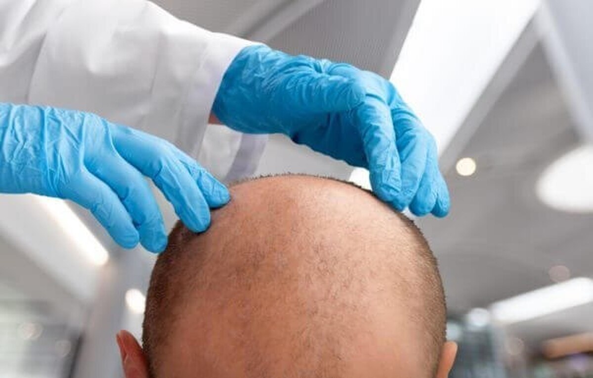 رایج‌ترین شکل ریزش مو در مردان چه مدلی است؟