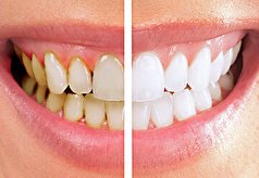 برای داشتن دندان‌هایی سفید و درخشان این اشتباهات را انجام ندهید