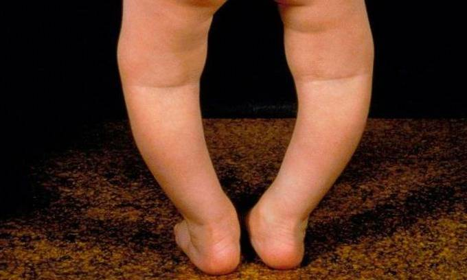 همه چیز درمورد پا‌های پرانتزی و نحوه تشخیص آن در کودکی