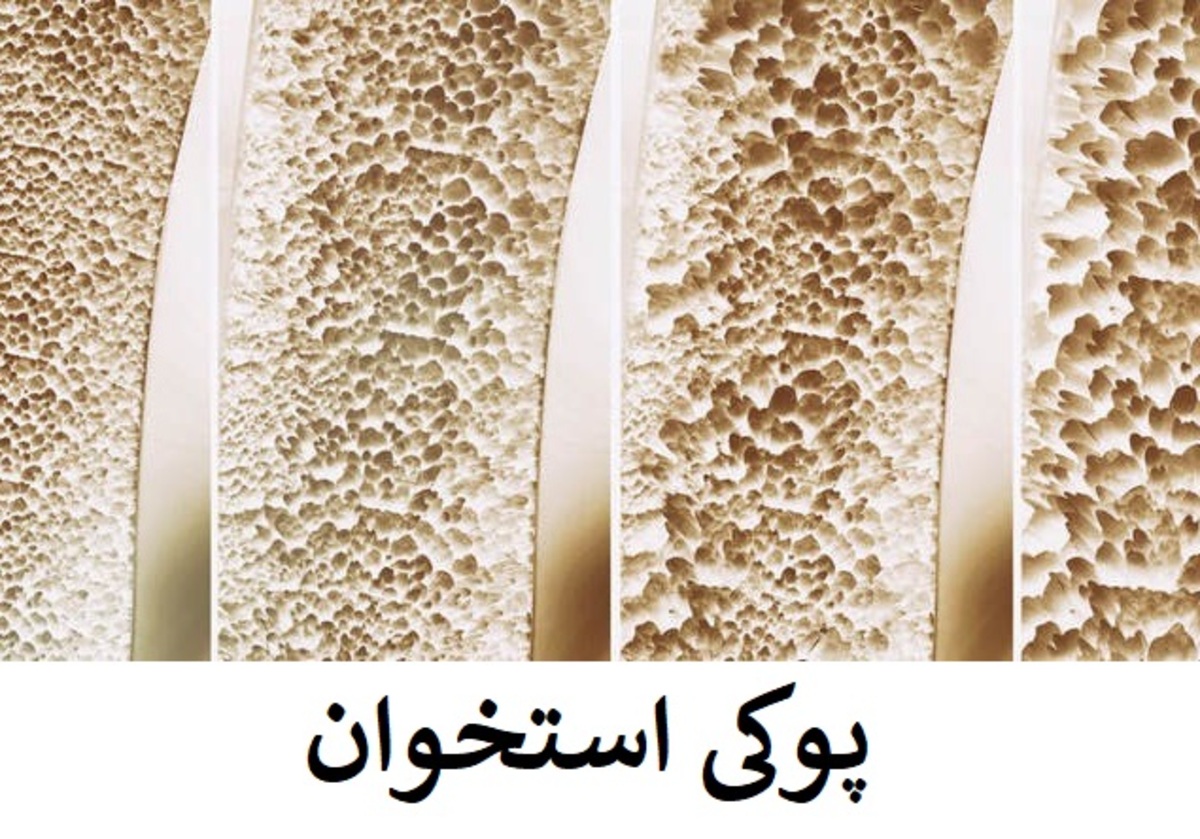 روش دگزا (DEXA) تراکم استخوان شما را میسنجد