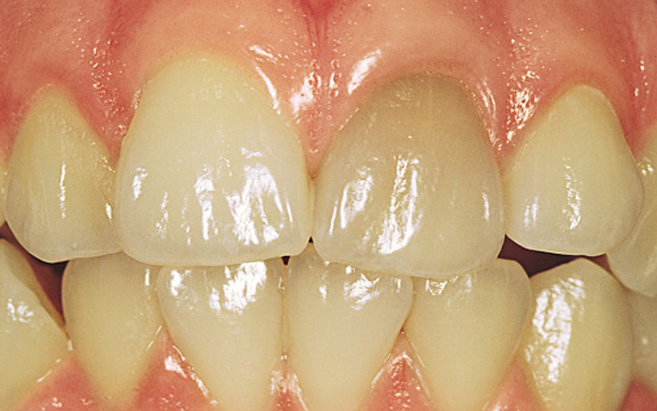 عوامل ایجاد لکه‌های زرد روی دندان‌ها را بشناسید