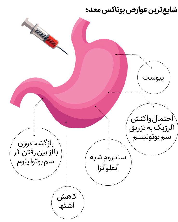 بوتاکس معده بدترین روش ممکن برای لاغری+عوارض