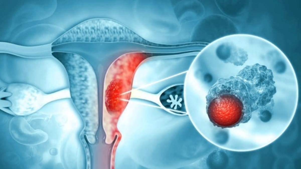 ویروس HPV مهم‌ترین عامل بروز سرطان دهانه رحم!
