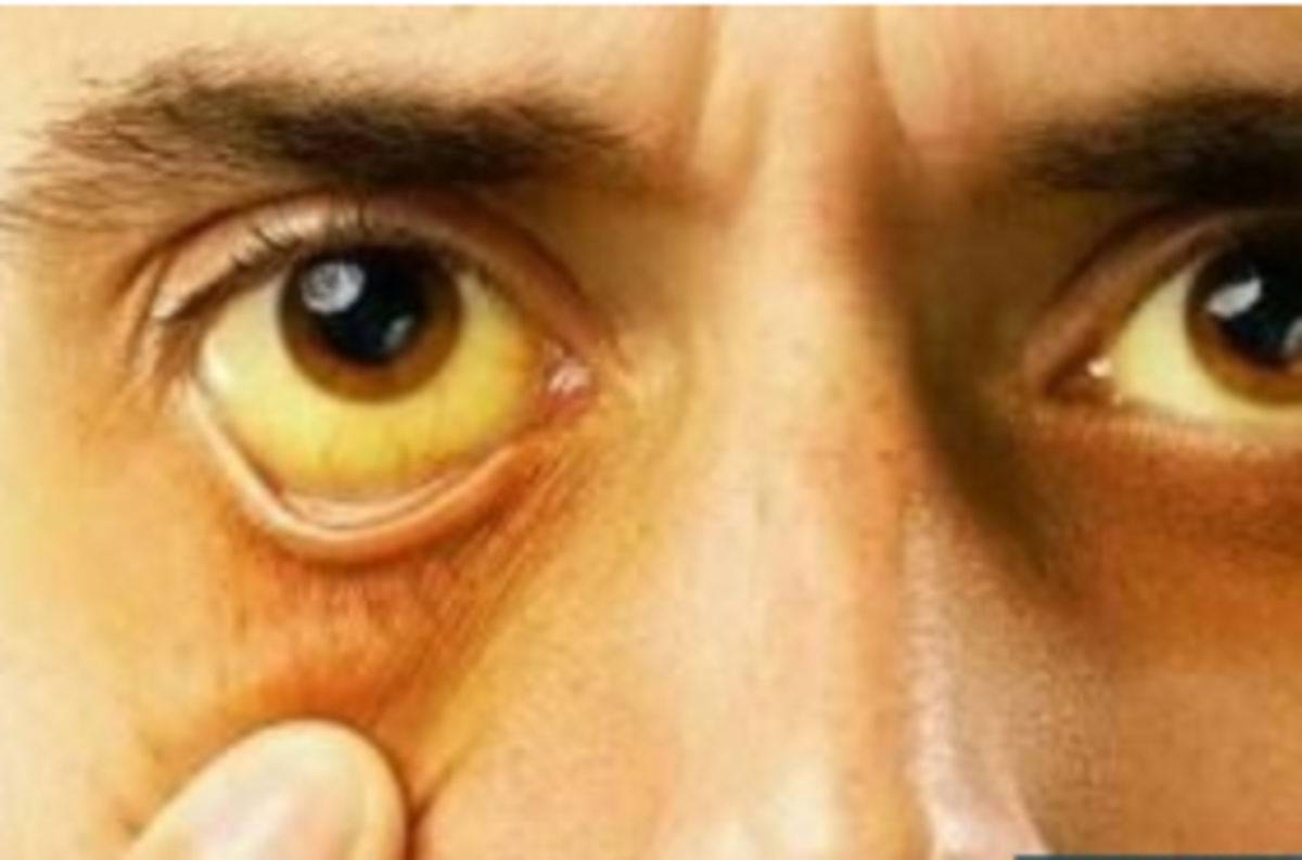 زردی چشم و پوست چه زمانی بسیار خطرناک است؟