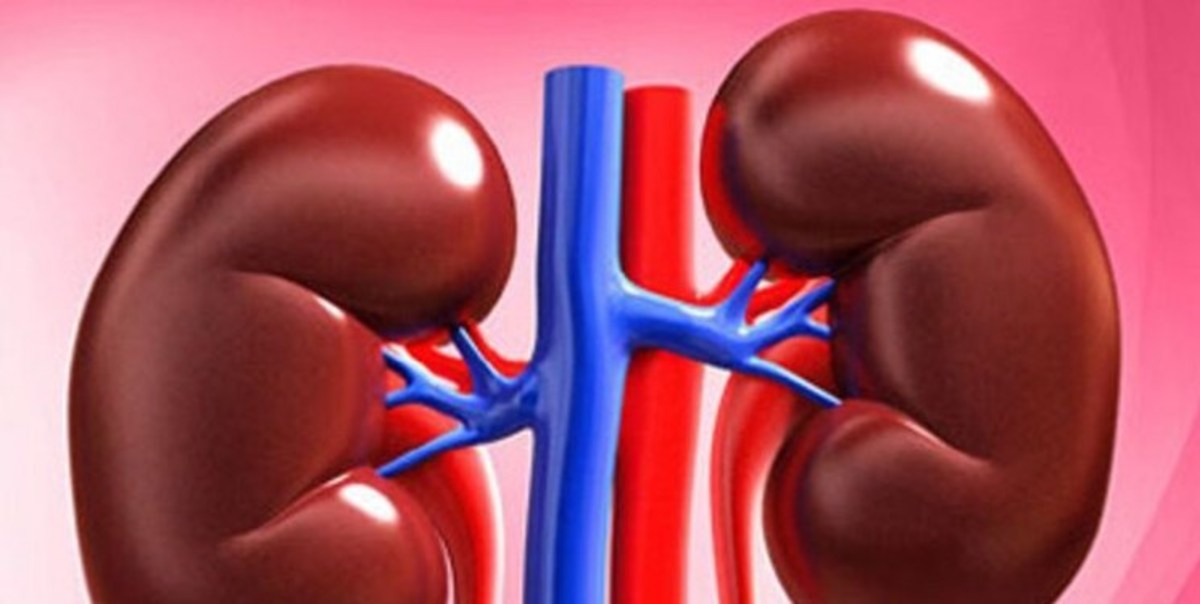 مهمترین علت ابتلا به سنگ کلیه
