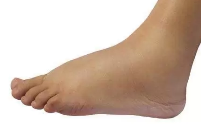 علت و درمان تورم قوزک پا
