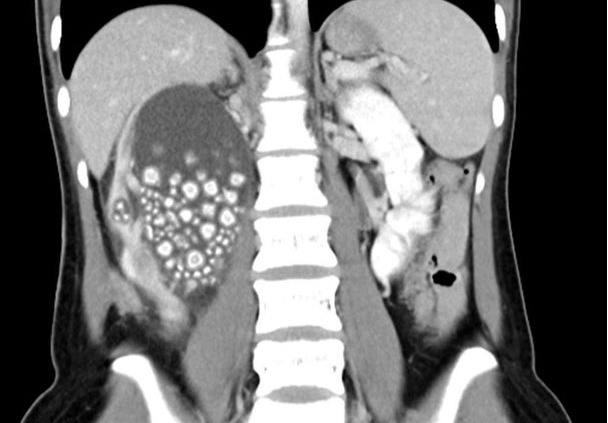 بیش از ۳۰۰ سنگ بعد از یک دهه آب نخوردن در کلیه زن تایوانی