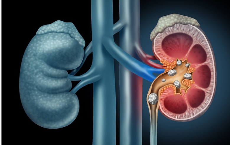 بیش از ۳۰۰ سنگ بعد از یک دهه آب نخوردن در کلیه زن تایوانی