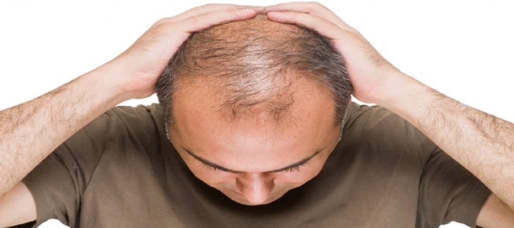 استرس ناشی برای از دست دادن موی سر باوجود پیشرفت چشم گیر صنعت بهداشتی