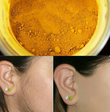 یک روش هندی برای از بین بردن مو‌های زائد با زردچوبه