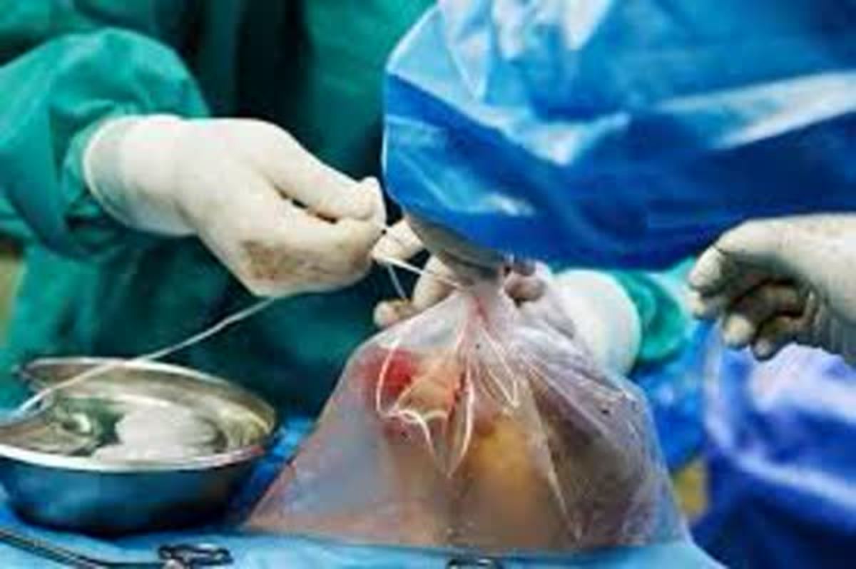 اعضای بیمار مرگ مغزی مشهدی جان چهار نفر را نجات داد