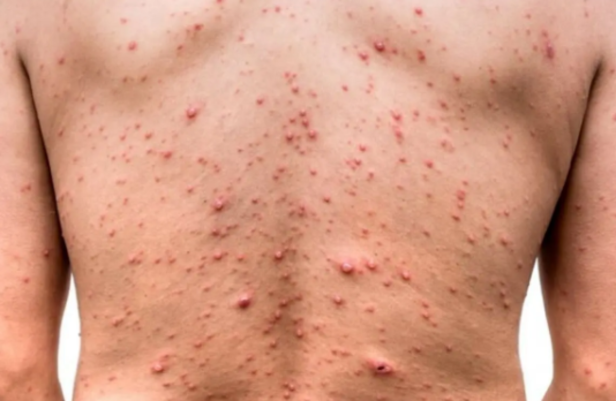 واکسن آبله مرغان در ایران موجود است؟