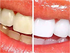 چرا دندان‌ها زرد می‌شوند؟ +راهکار سفید کردن