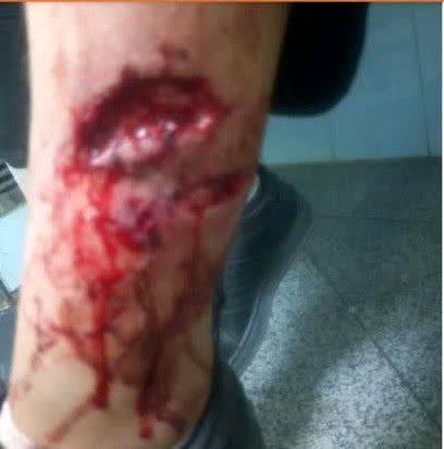 حمله سگ‌های ولگرد به دانش‌آموز دماوندی + تصاویر