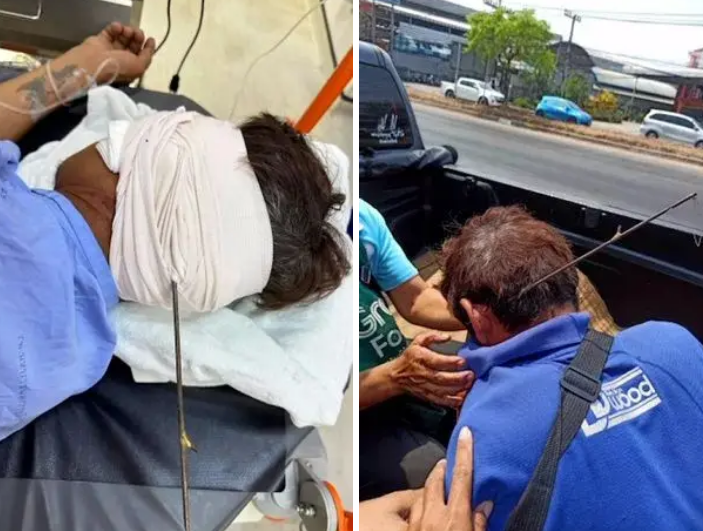 مرد خوش شانس تایلندی که با وجود فرو رفتن یک نیزه ماهیگیری در سرش باز هم جان سالم به در کرد