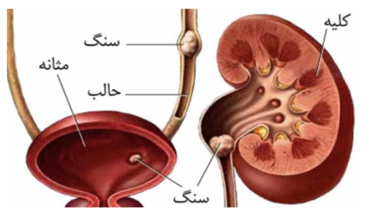 علائم هشداردهنده سنگ کلیه!