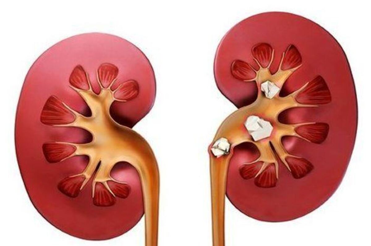 چگونه از ابتلا به سنگ کلیه جلوگیری کنیم؟