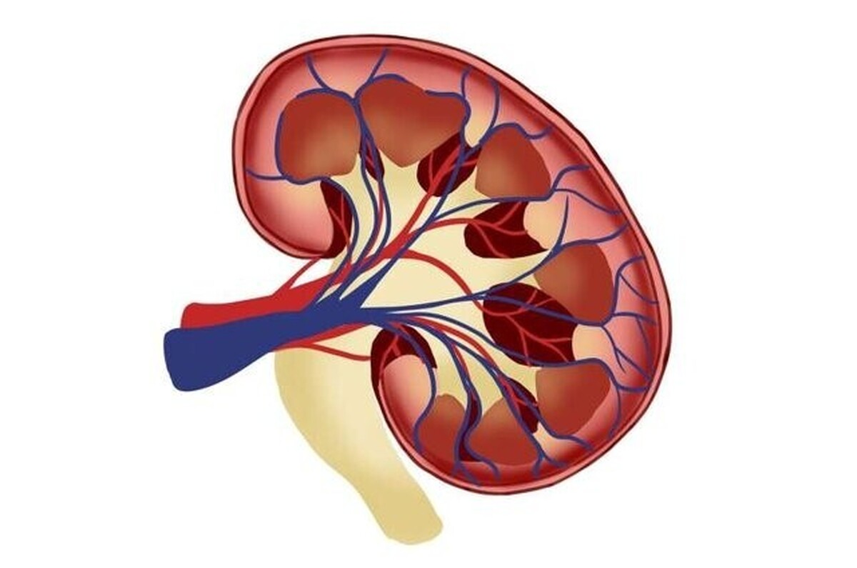 سنگ کلیه چگونه ایجاد میشود؟