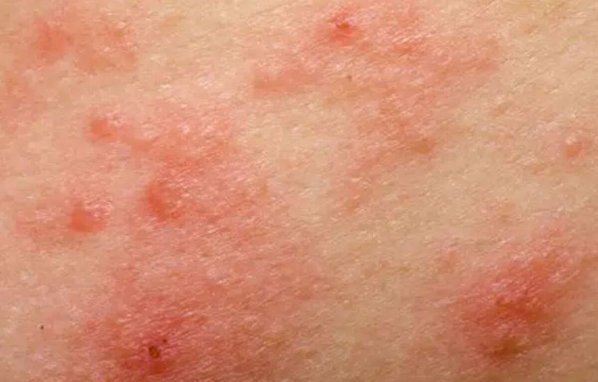 RSV چیست؟ /با نشانه‌های این بیماری پوستی بیشتر آشنا شوید
