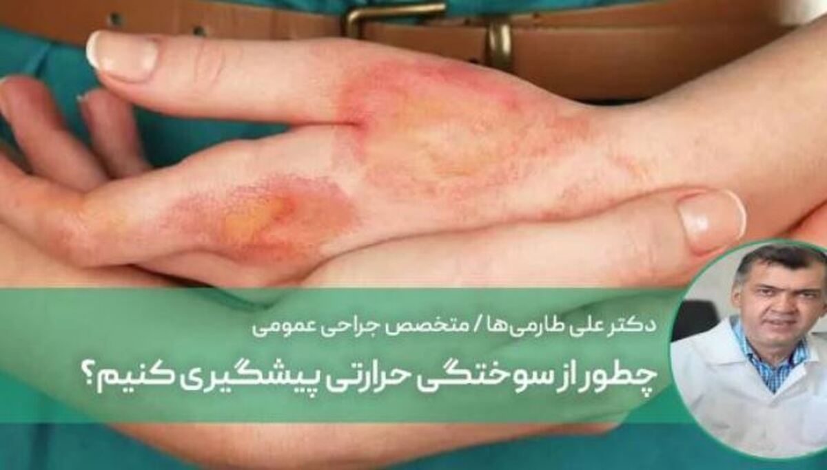 چگونه از سوختگی حرارتی پیشگیری کنیم؟