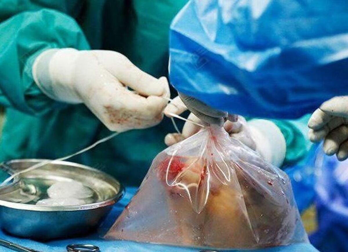 از بین تمامی ریه‌های اهدایی فقط ۴ درصد آنها قابل استفاده‌اند