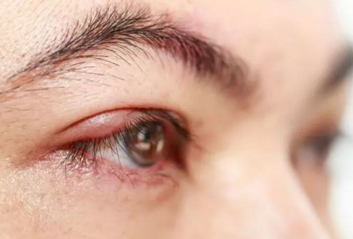 راهکار‌های خانگی برای بهبود و درمان گل مژه