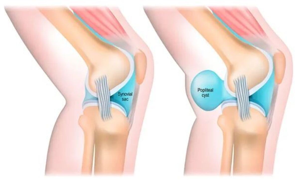 چگونه از مبتلا شدن به کیست بیکر جلوگیری کنیم؟
