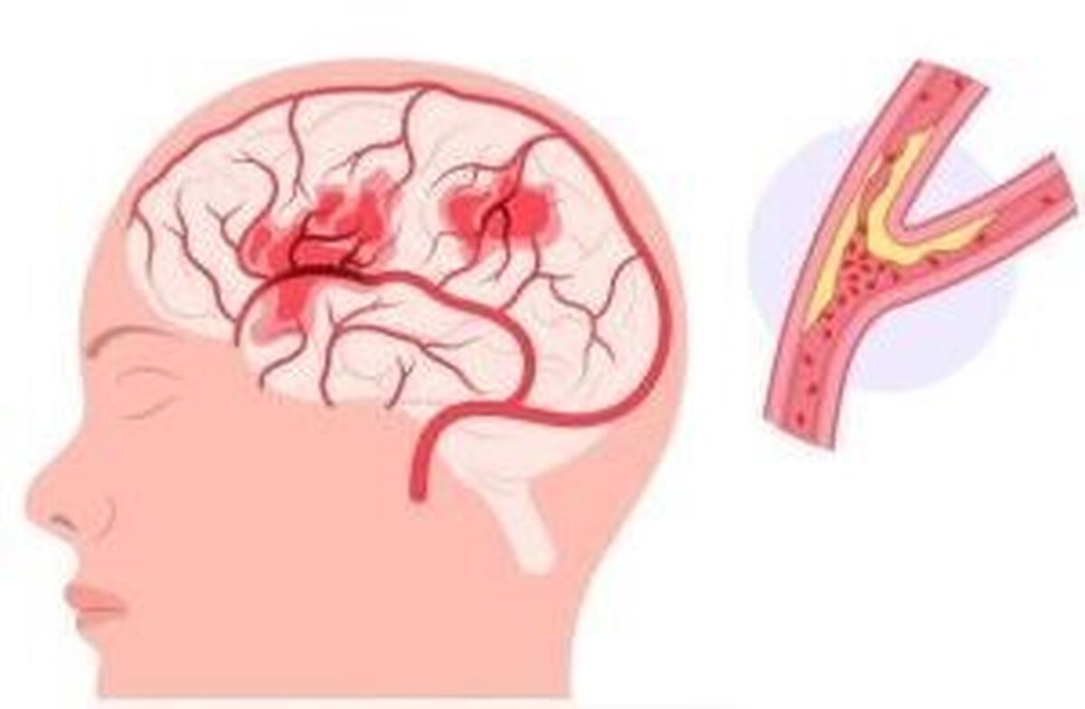 تفاوت مهم بین (TIA) و سکته مغزی