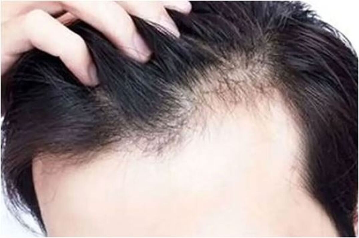 ویتامین‌های مهم در حفظ سلامتی مو‌ها را بشناسید