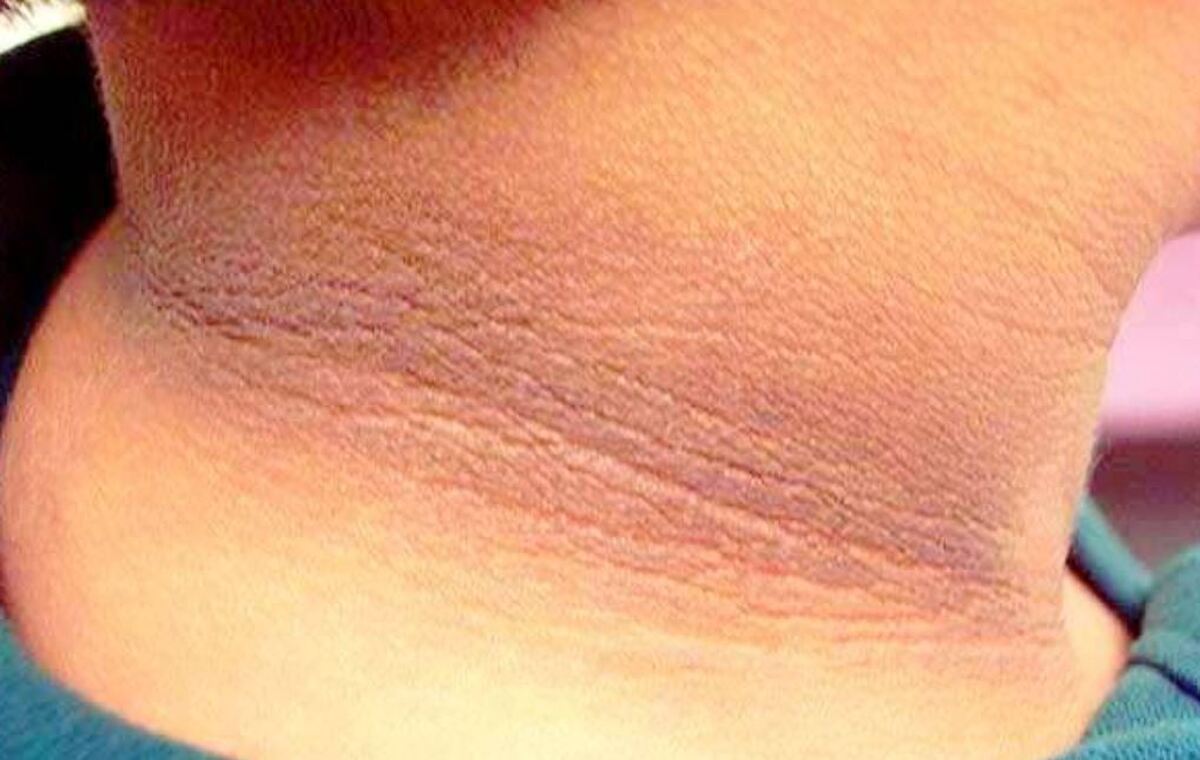 ۱۷ مشکل پوستی که بیماران دیابتی را درگیر می‌کند