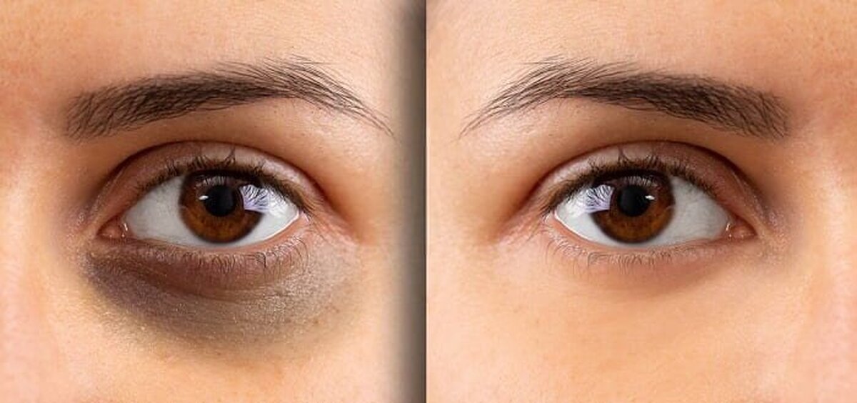 چه چیزی باعث تیرگی دور چشم می‌شود؟