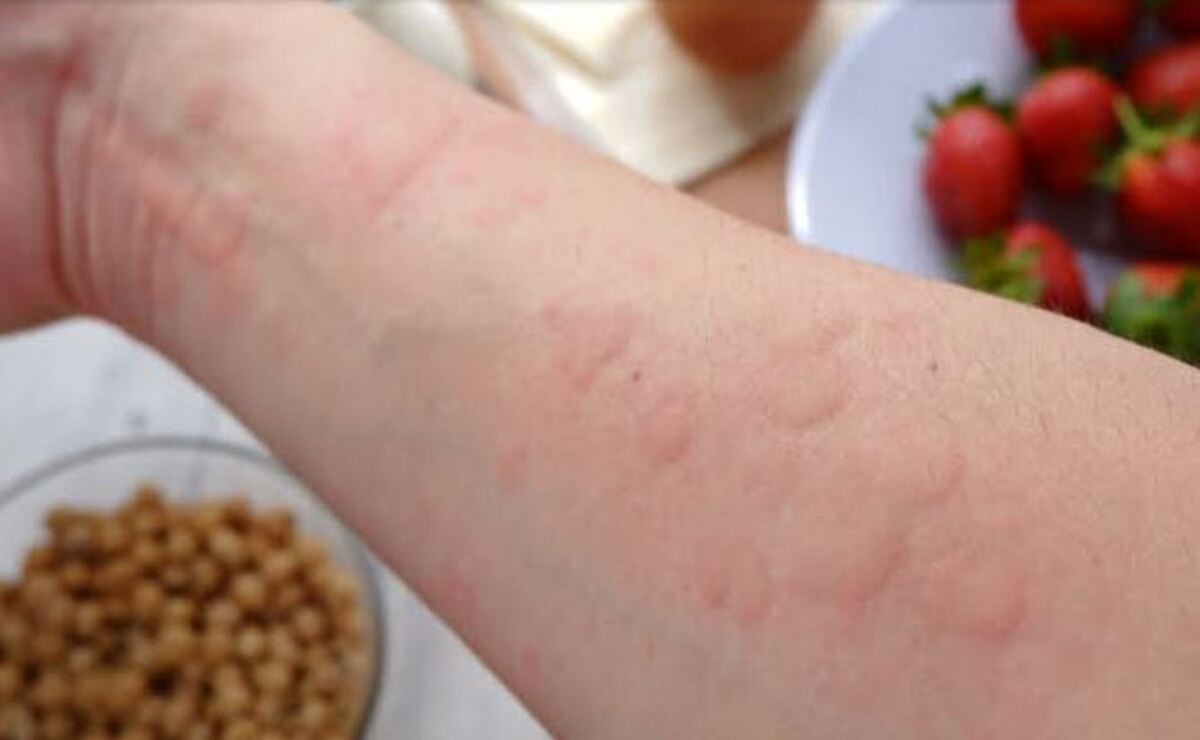 حساسیت به مواد خوراکی چگونه رخ میدهد؟