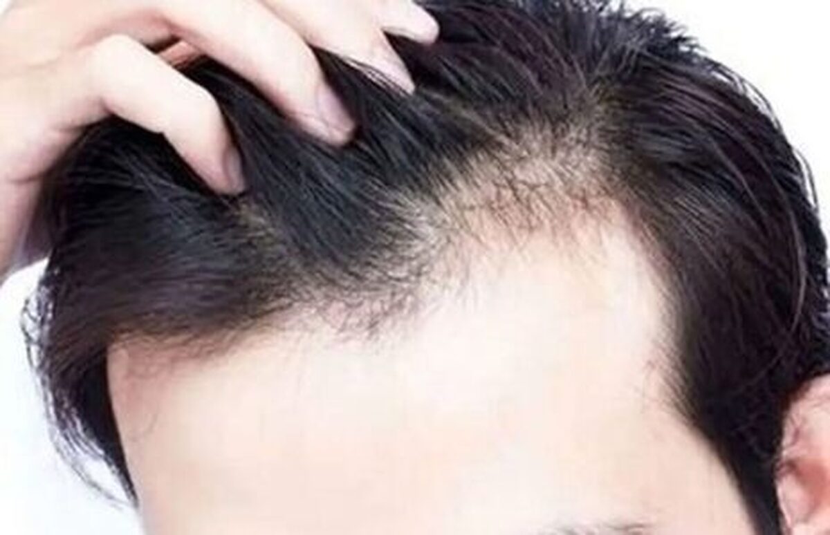 چه زمانی ریزش مو طبیعی نیست؟